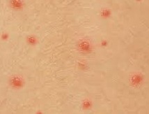 Chicken Pox and Shingles information sheet